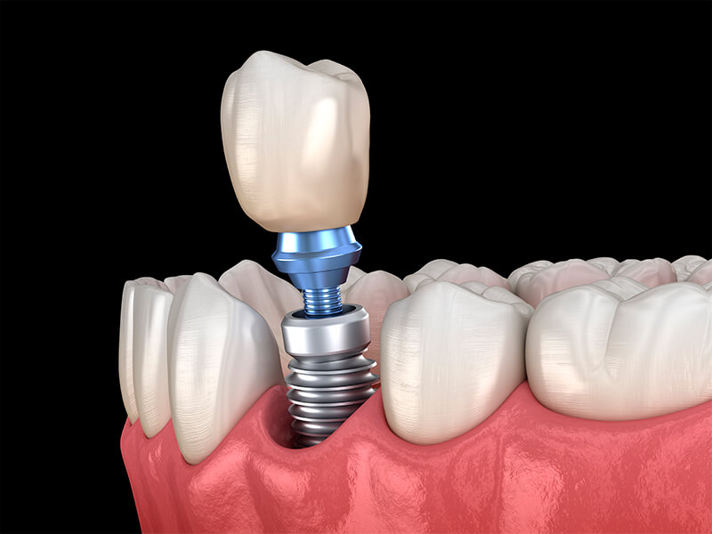 Implantes Dentários