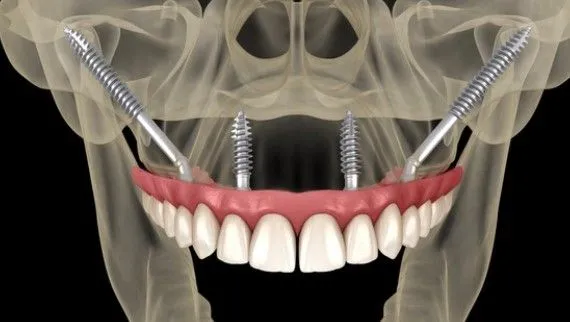 Implantes Zigomáticos